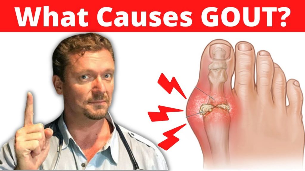 What Causes GOUT? (Meat Doesn't Cause Gout) 2023 Awesome Online Deals